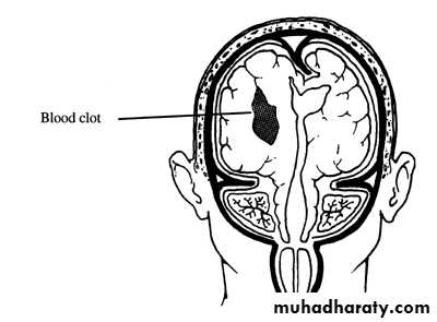 Neurosurgery