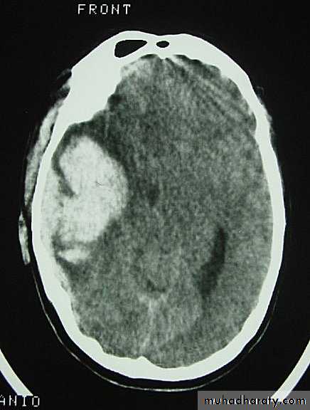 Neurosurgery