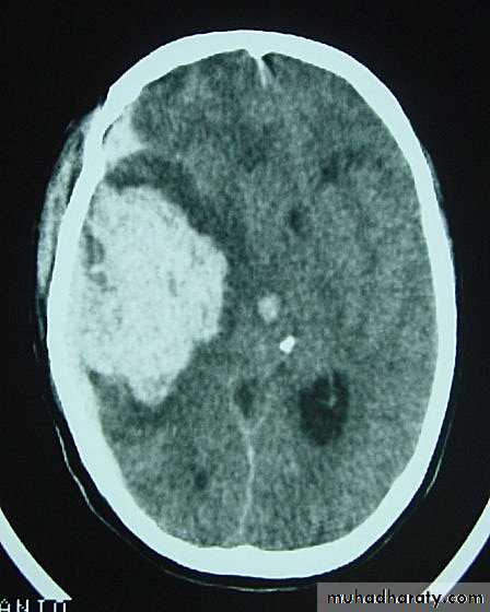 Neurosurgery