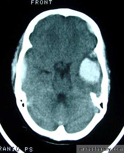 Neurosurgery