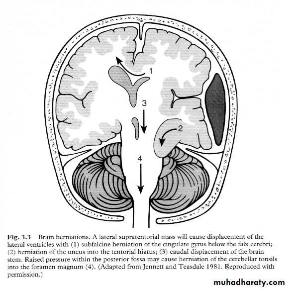 Neurosurgery