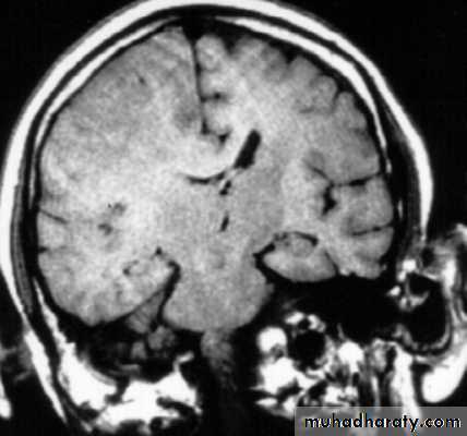 Neurosurgery
