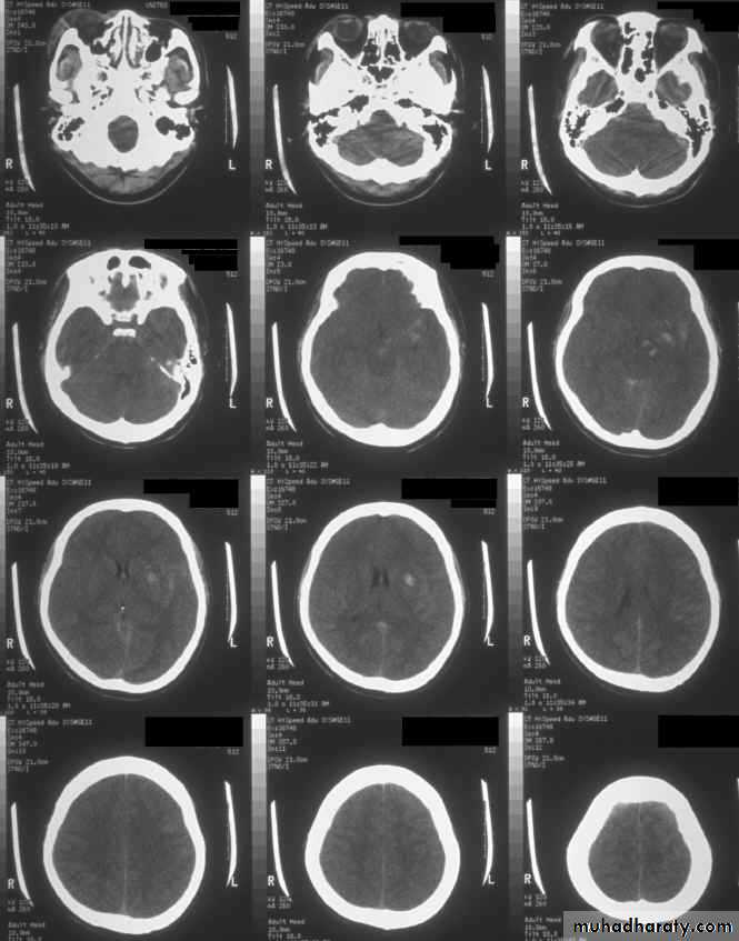 Neurosurgery