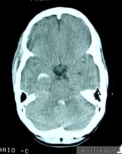 Neurosurgery