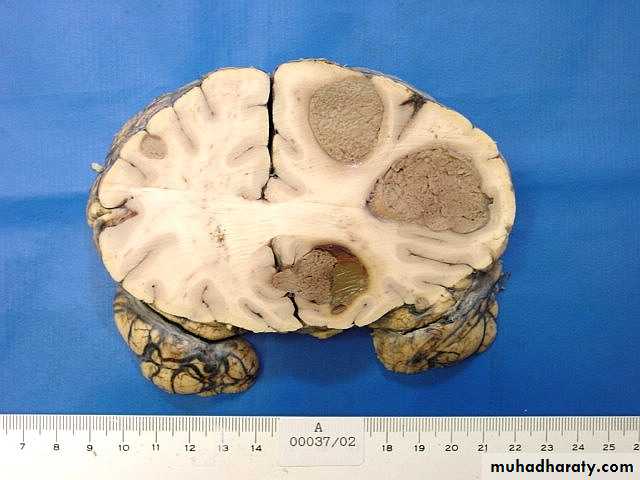 Neurosurgery