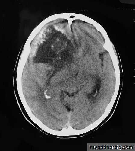 Neurosurgery