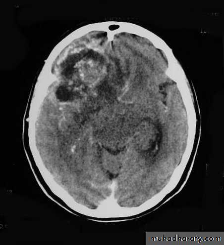 Neurosurgery