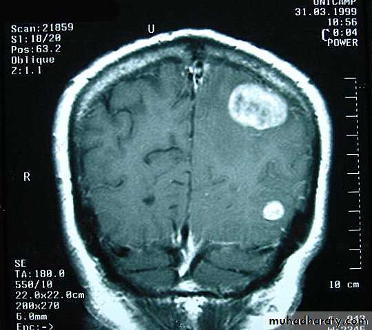 Neurosurgery
