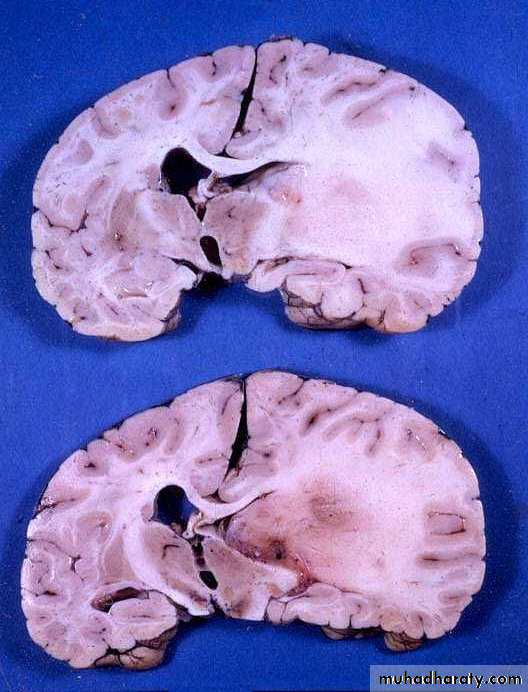 Neurosurgery