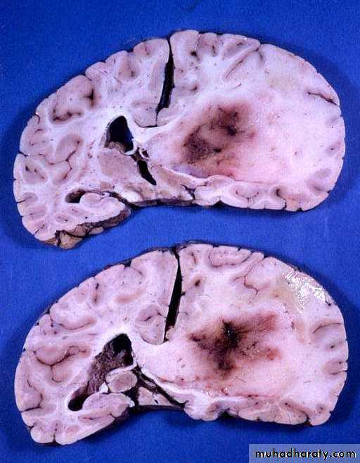 Neurosurgery