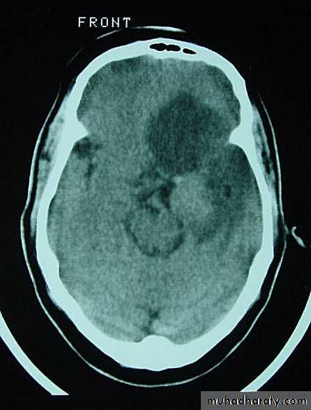 Neurosurgery