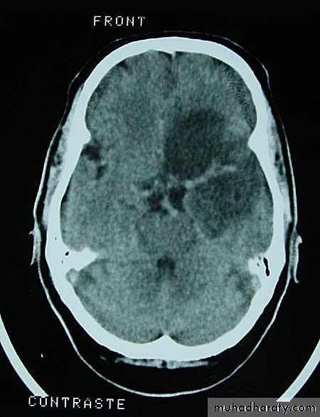 Neurosurgery
