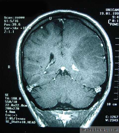 Neurosurgery