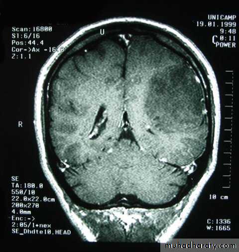 Neurosurgery