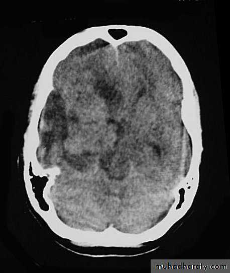 Neurosurgery