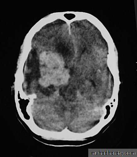 Neurosurgery