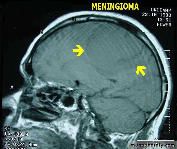 Neurosurgery