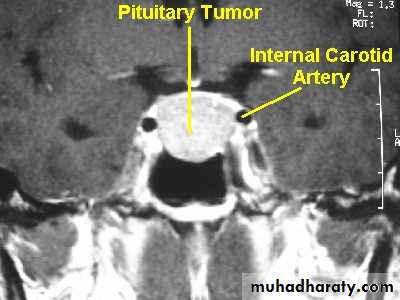 Neurosurgery