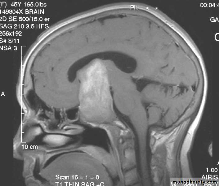Neurosurgery
