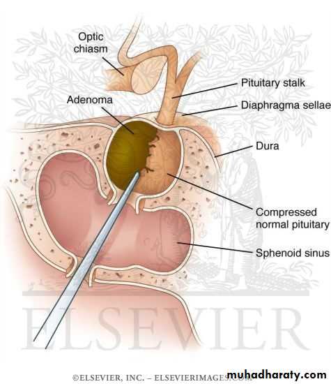 Neurosurgery