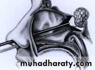 Neurosurgery