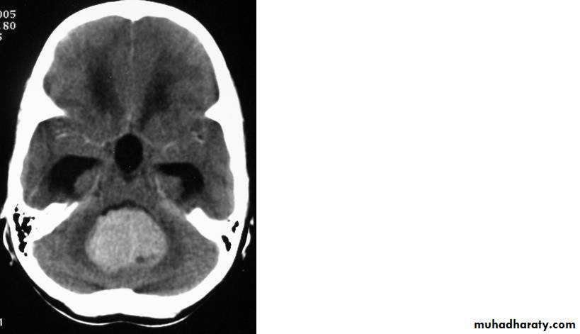 Neurosurgery