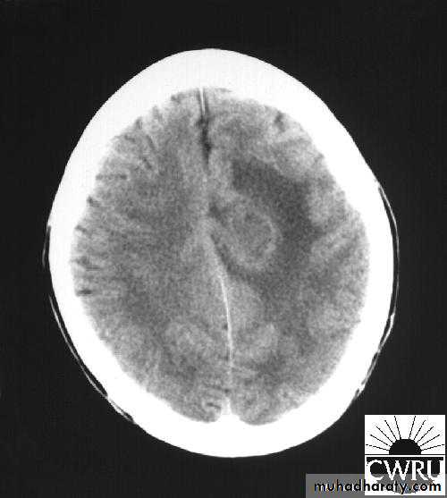 Neurosurgery