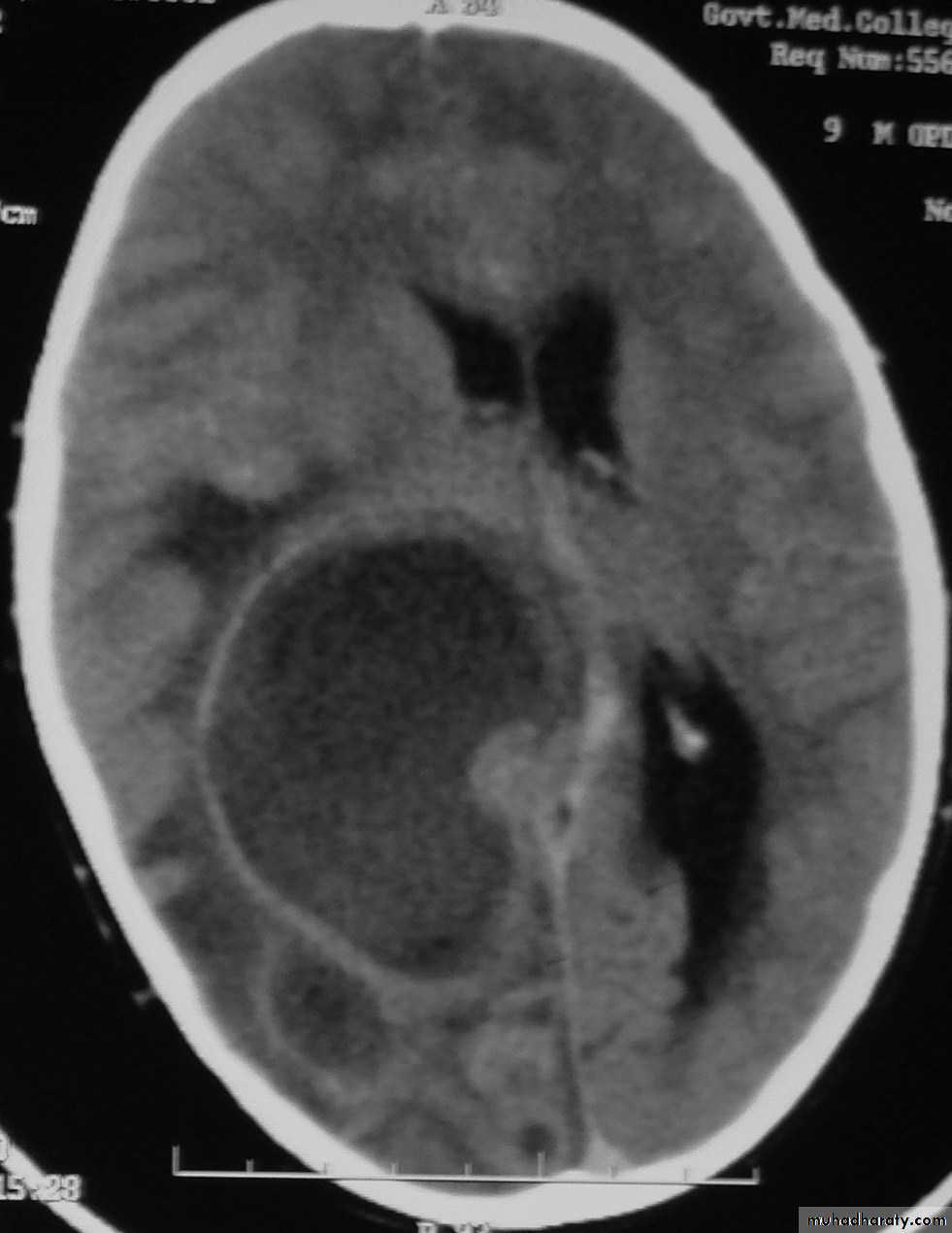 Neurosurgery
