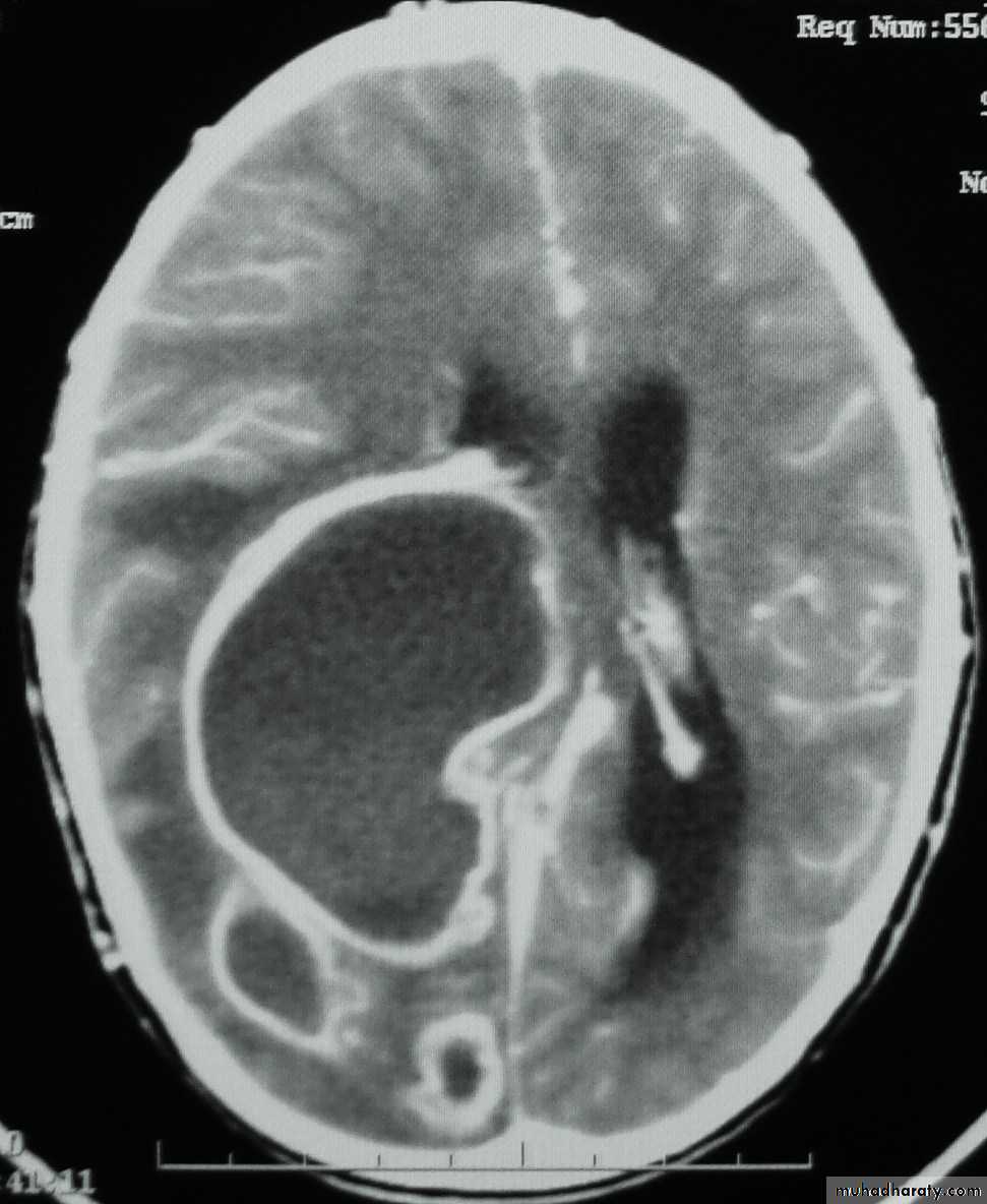 Neurosurgery