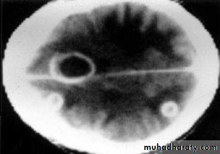 Neurosurgery