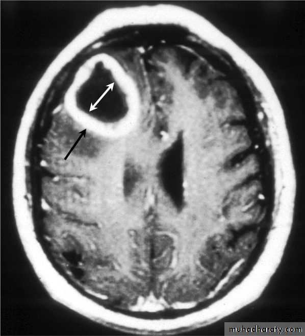 Neurosurgery