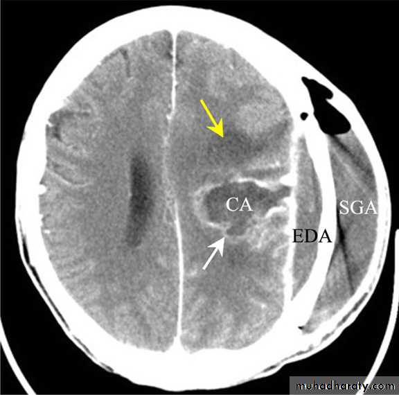 Neurosurgery