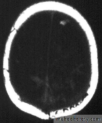 Neurosurgery