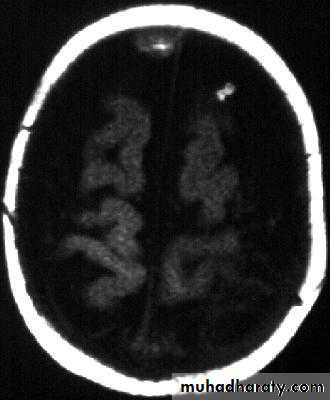 Neurosurgery