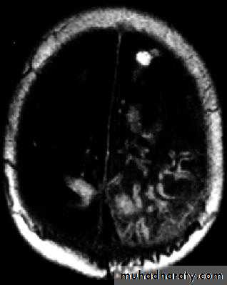 Neurosurgery