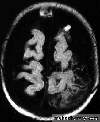 Neurosurgery