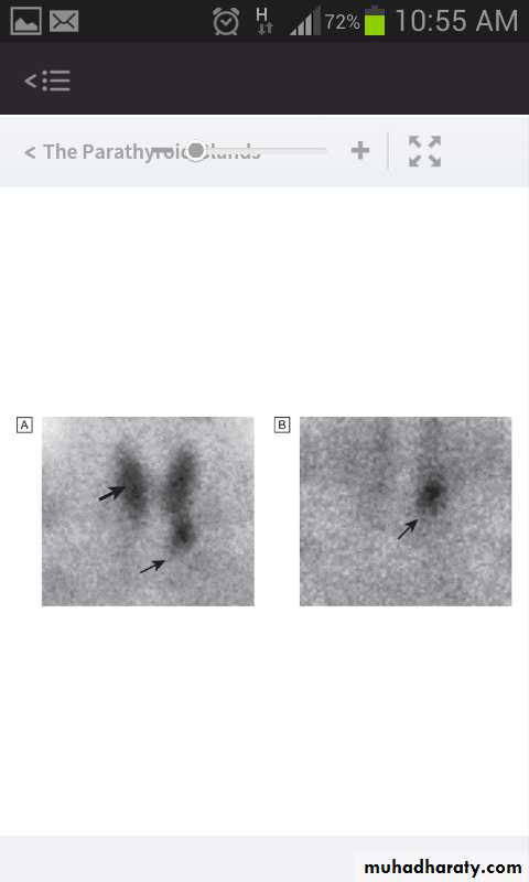 parathyroid
