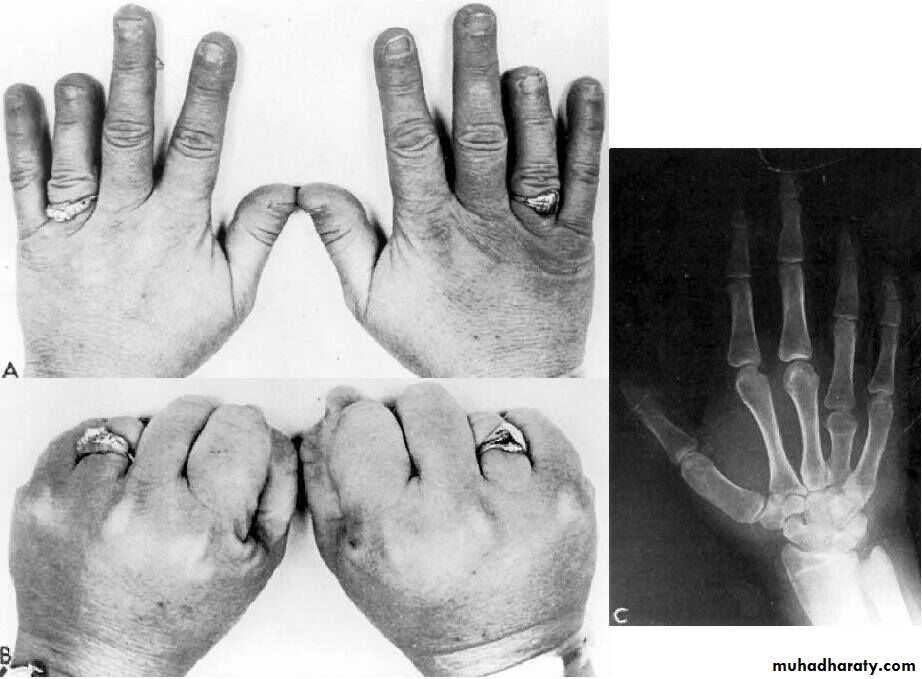 parathyroid
