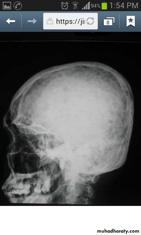 parathyroid