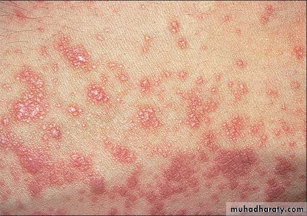 disease of vulva