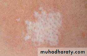 disease of vulva