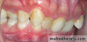cl ll malocclusion div 2