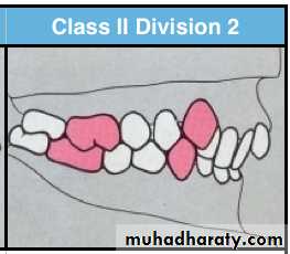 cl ll malocclusion div 2