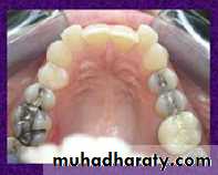 cl ll malocclusion div 2