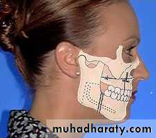 cl ll malocclusion div 2