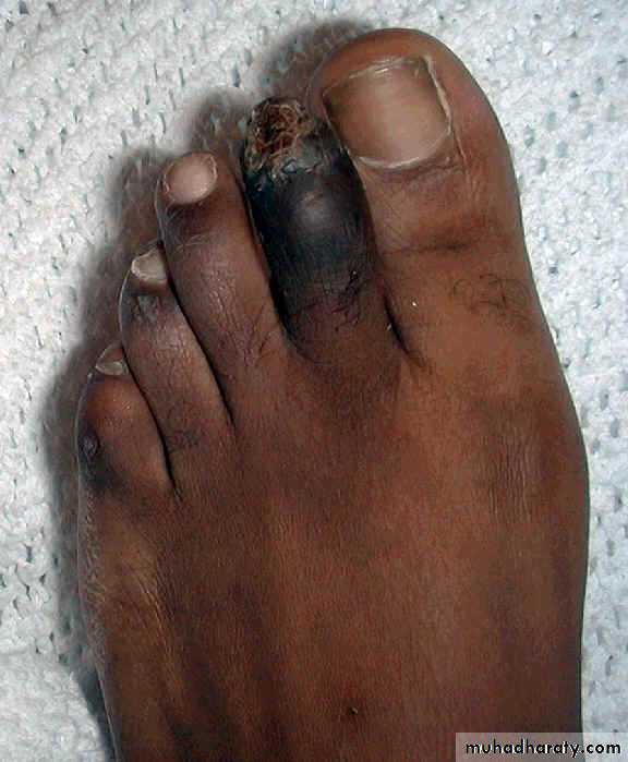 Diabetic foot