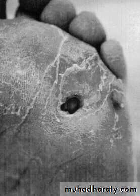 Diabetic foot