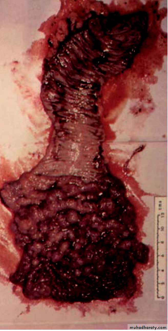 large bowel