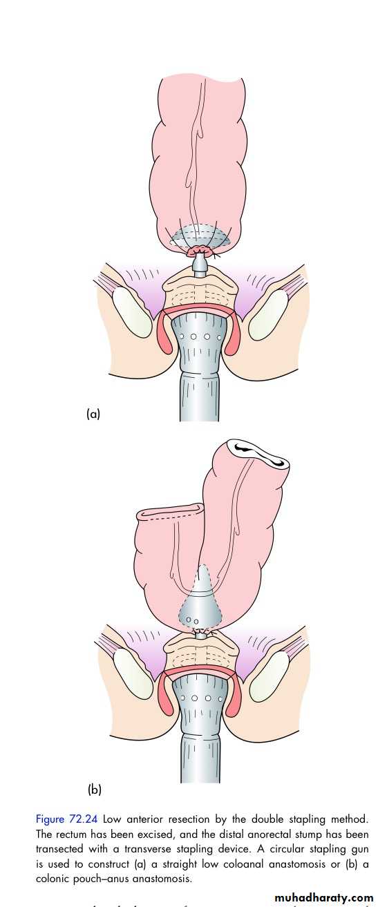 large bowel