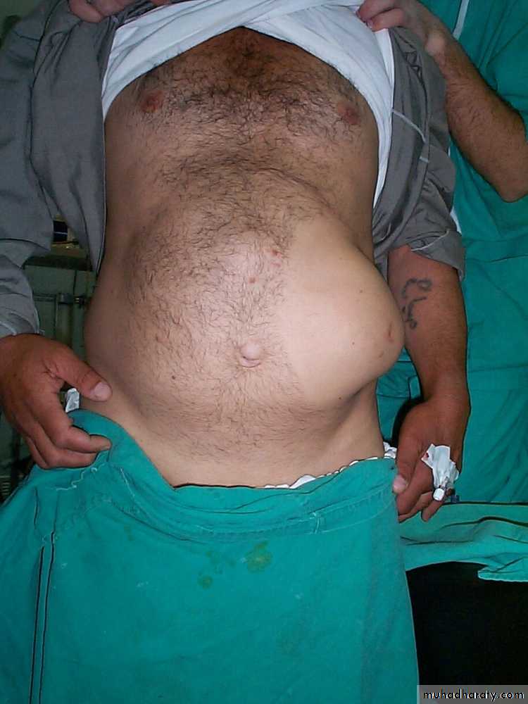 Abdominal wall Hernia